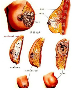 乳腺结节是怎么回事